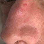 Skin Cancer (14 Treatments) Case-42 Before