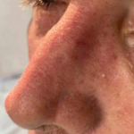 Skin Cancer (14 Treatments) Case-42 After