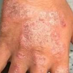 Psoriasis Before and After Case 5 Before