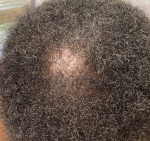 Hair Loss Case-12 Before