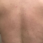 Psoriasis (3 Month Cosentyx) Case-39 After