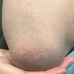 Psoriasis (6 Month Taltz) Case-41 Before
