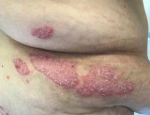 Psoriasis Before and After Case 7 Before