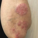 Psoriasis (6 Month Cosentyx) Case-11 After