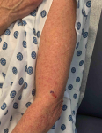 Psoriasis (6 Month Taltz) Case-45 Before