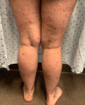 Psoriasis (6 Month Cimzia) Case-49 Before