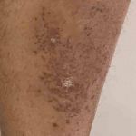 Psoriasis (6 Month Stelera) Case-50 After