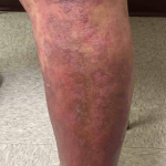 Psoriasis (6 Months Cosentyx) Case-53 Before