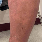 Psoriasis (6 Months Cosentyx) Case-53 After