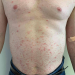 Psoriasis (3 Months Skyrizi ) Case-59 Before