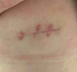 Skin Cancer (Excision) Case-43 After