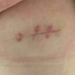 Skin Cancer (Excision) Case-43 After