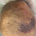Skin Cancer (14 Treatments) Case-49 Before