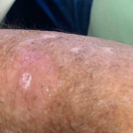 Skin Cancer (14 Treatments) Case-49 After
