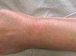 Skin Cancer (14 Radiation Treatment) Case-51 After