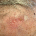 Skin Cancer (17 Radiation Treatment) Case-53 Before