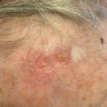 Skin Cancer (17 Radiation Treatment) Case-53 Before
