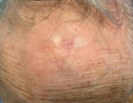Skin Cancer (17 Radiation Treatment) Case-53 After