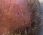 Skin Cancer (17 Radiation Treatment) Case-58 Before