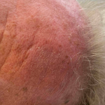 Skin Cancer (17 Radiation Treatment) Case-58 After