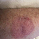 Skin Cancer (14 Radiation Treatment) Case-60 After