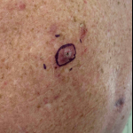 Skin Cancer (Excision) Case-61 Before