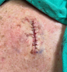 Skin Cancer (Excision) Case-61 After