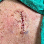 Skin Cancer (Excision) Case-61 After