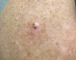 Skin Cancer (Excision) Case-62 Before