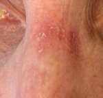 Skin Cancer (17 Radiation Treatment) Case-63 After
