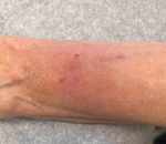 Skin Cancer (14 Radiation Treatment) Case-64 After