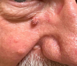 Skin Cancer (17 Radiation Treatment) Case-66 Before
