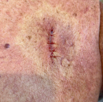 Cyst Removal Before and After Case 16 After