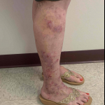 Atopic Dermatitis Before and After Case-35 Before