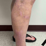 Atopic Dermatitis Before and After Case-35 After