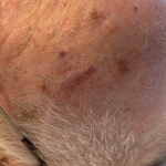 Skin Cancer Before and After Case 73 Before