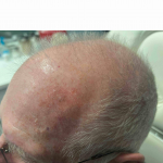 Skin Cancer Before and After Case 73 After