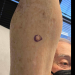 Skin Cancer Before and After Case 74 Before