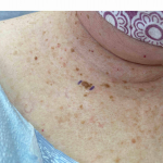 Skin Cancer Before and After Case 75 Before