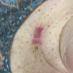 Skin Cancer Before and After Case 75 After