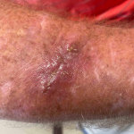 Skin Cancer Before and After Case 77 After