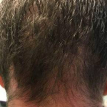 Hair Loss Before and After Case 6 After