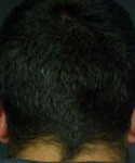Hair Loss Before and After Case 8 After