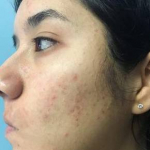 Acne Before and After Case 2 Before