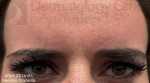 Xeomin (25 Units Glabella) Case-2 After
