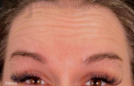 Xeomin (20 Units Forehead) Case-7 Before