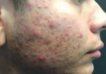 Acne Before and After Case 4 Before