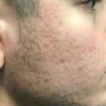 Acne Before and After Case 4 After