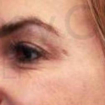 BOTOX (25 units) Case-1 After