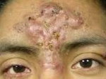 Acne Before and After Case 6 Before